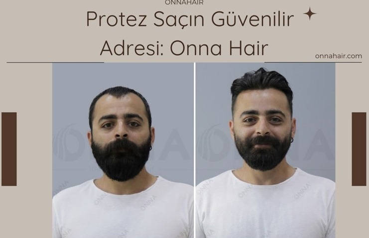 Protez Saçın Güvenilir Adresi: Onna Hair